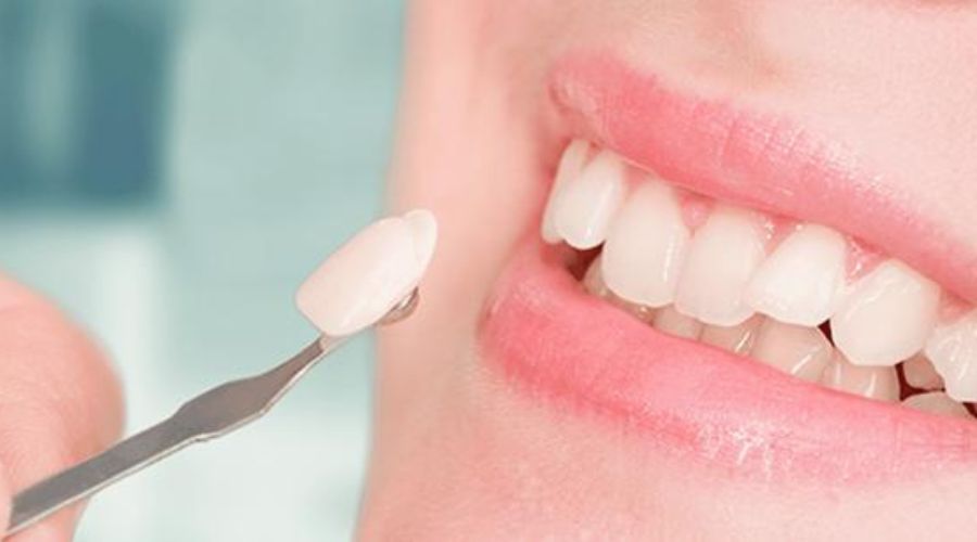 Dán Sứ Veneer