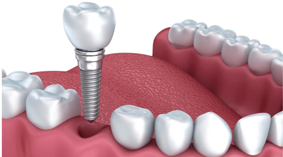 Làm thế nào để rút ngắn thời gian cấy ghép Implant