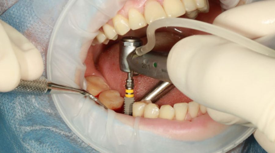 Phẫu thuật cấy ghép trụ Implant