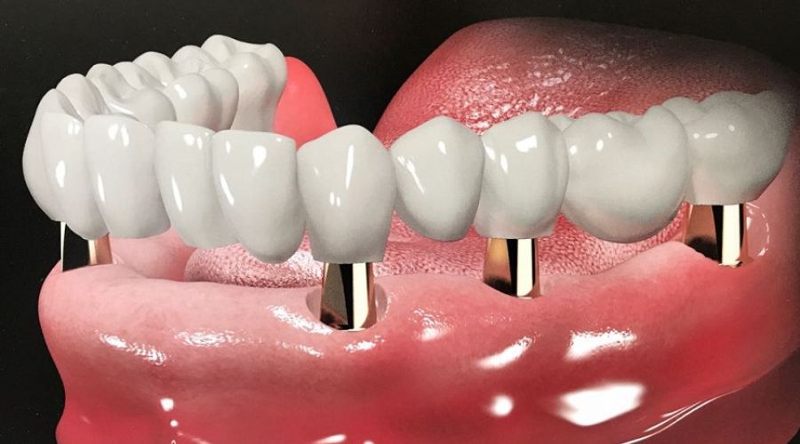 Quy trình phục hình toàn hàm bằng Implant tại nha khoa Hello