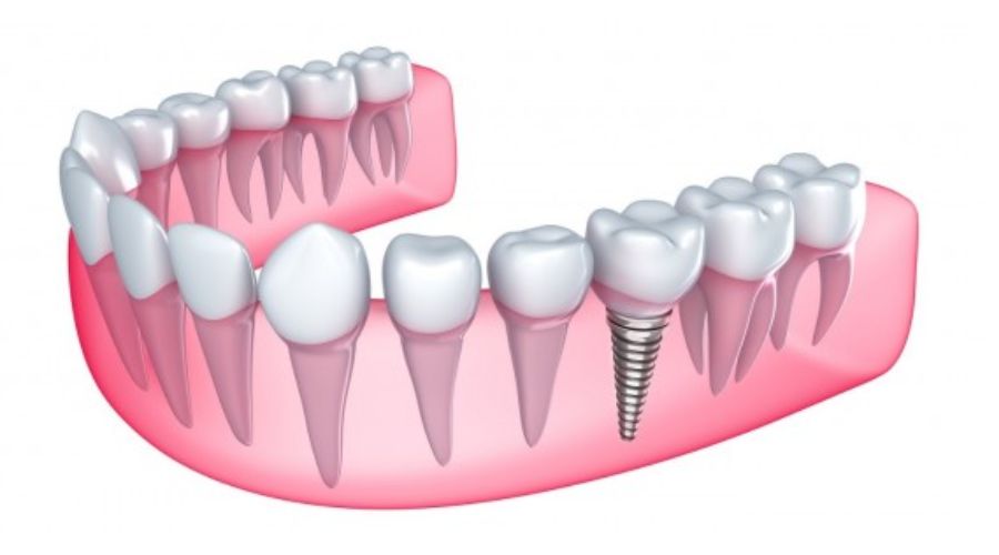 Thời gian cấy ghép Implant