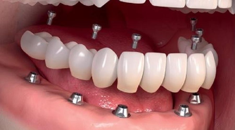 Tìm hiểu chung về phục hình toàn hàm bằng Implant