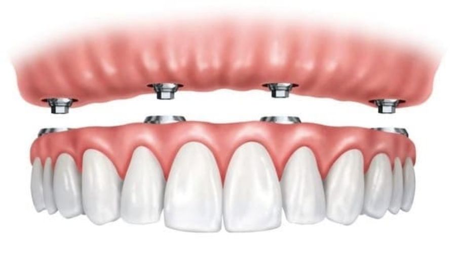 Ưu điểm của phục hình toàn hàm bằng Implant so với hàm giả tháo lắp