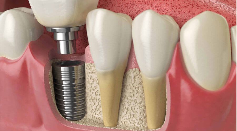 Yếu tố ảnh hưởng đến thời gian cấy ghép Implant