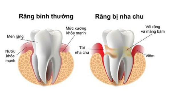 Giới Thiệu Về Bệnh Nha Chu