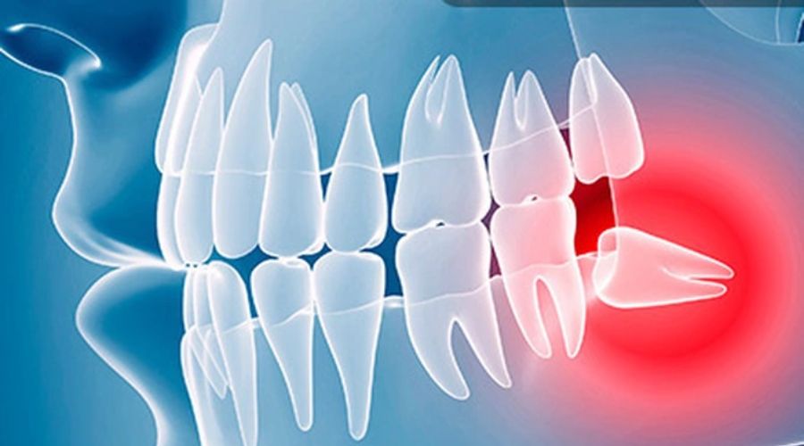 Lợi Ích Của Việc Nhổ Răng Khôn