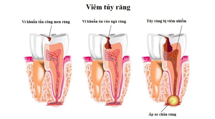 Nguyên Nhân Gây Viêm Tủy Răng