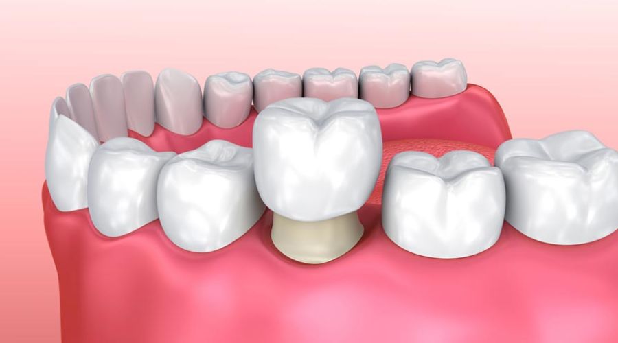 Hướng Dẫn Chăm Sóc Răng Sứ Sau Khi Cấy Ghép