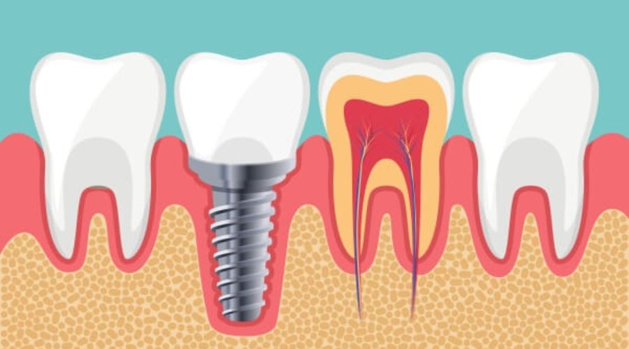 Implant Nha Khoa Là Gì