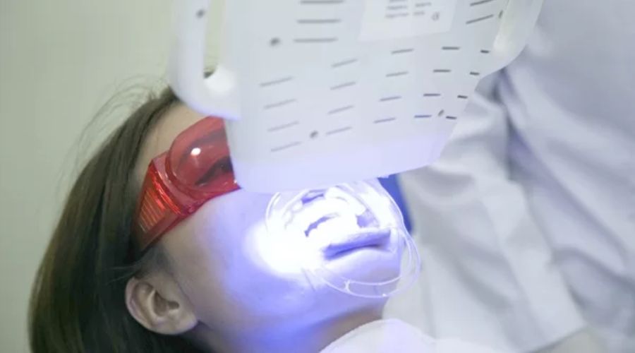 Lợi Ích Của Tẩy Trắng Răng Bằng Laser