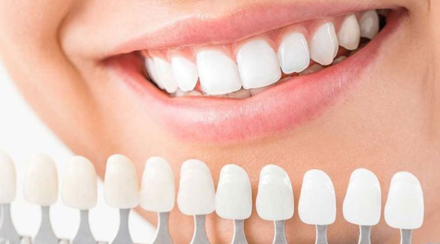 Quy Trình Lắp Đặt Răng Sứ Zirconia