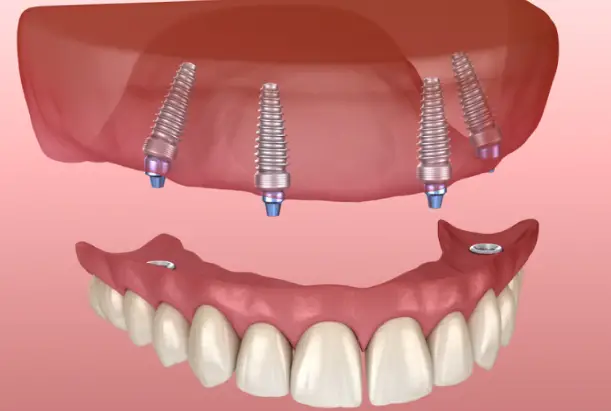 Hàm giả tháo lắp trên implant thực hiện tại nha khoa Hello, bác sĩ Hoàng Anh